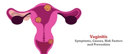 Vaginitis- Symptoms, Causes, Risk Factors and Prevention