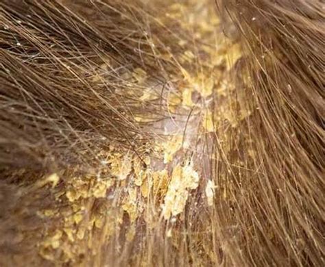 Severe Dandruff Scalp