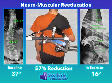 Exercises Scoliosis Exercises