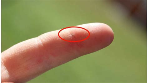 Infected sliver in finger: Splinter, First Aid: Condition, Treatments, and Pictures – First Aid ...