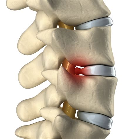 Herniated Disc / Bulging Disc / Protruding Disc - Michigan Spine & Pain