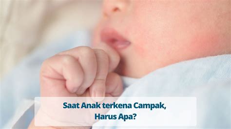 Saat Anak terkena Campak, Harus Apa? - Primaya Hospital