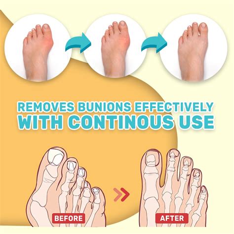 2022 Reliable DeltaNatural Bunion Toe Stiffness Relief Cream