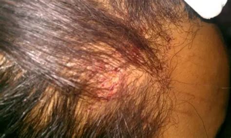 Scabs on Scalp: Causes, Treatment & Remedies | Treat, Cure Fast