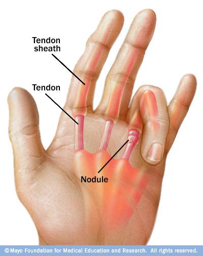 Hand / Finger Tendinitis | 👨‍⚕️Singapore Orthopaedic & Neurosurgery Clinic