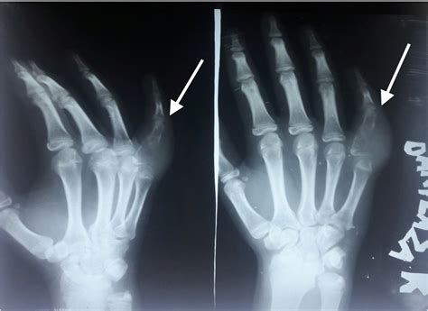 Cureus | Unusual Presentation of a Rare Tumor: Histiocytic Sarcoma Presenting as a Finger Growth