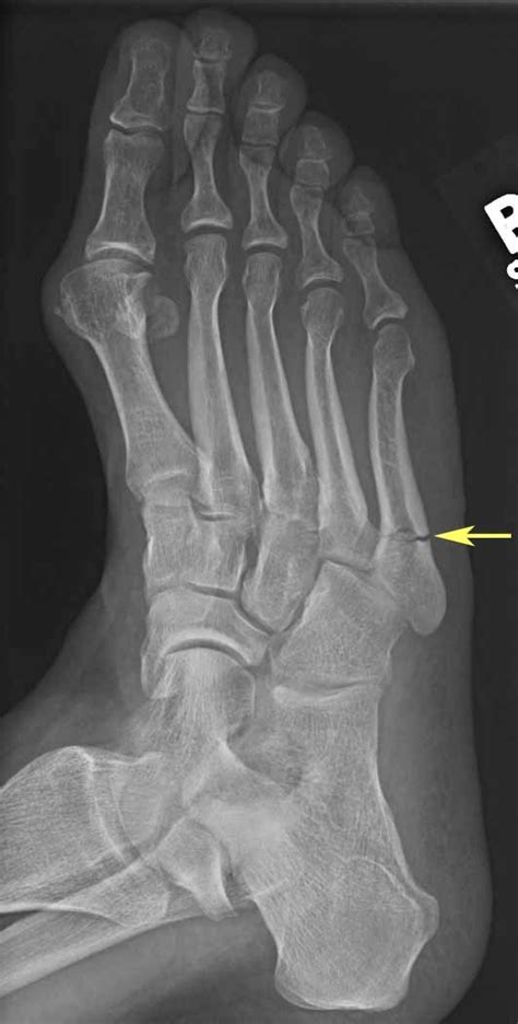 Jones Fracture (X-Ray) - radRounds Radiology Network