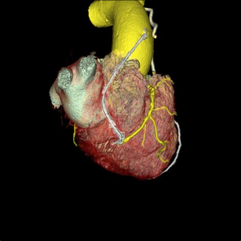 Coronary Artery Bypass Graft - Physiopedia