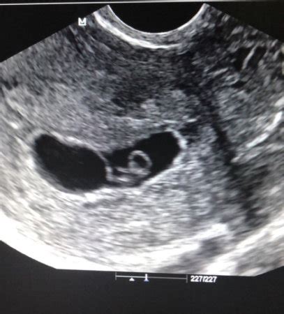 First ultrasound- vanishing twin | BabyCenter