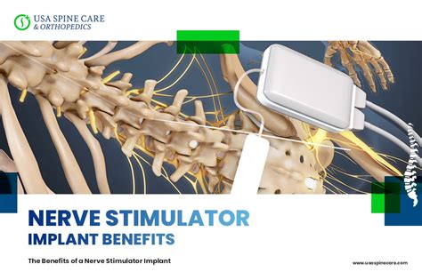 Benefits of a Nerve Stimulator Implant - USA Spine Care