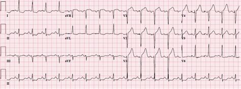 Dr. Smith's ECG Blog: LVH with anterior ST Elevation. When is it anterior STEMI?