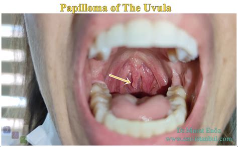 Throat Uvula Surgery