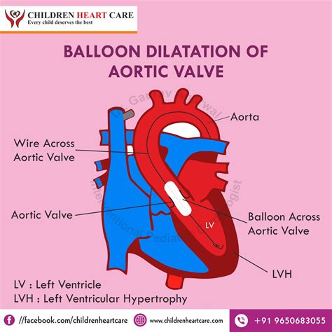 Aortic Stenosis Treatment in Delhi : Dr. Gaurav Agrawal