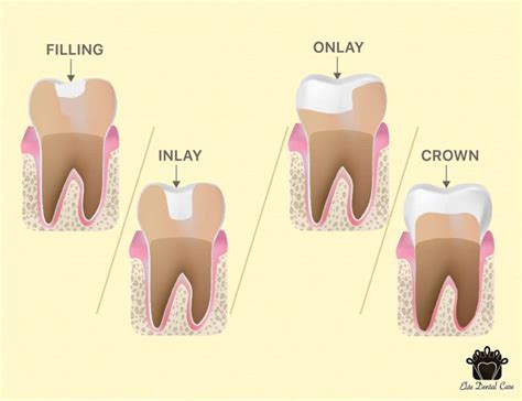 Fillings VS Inlay/Onlay VS Crown - Elite Dental Care Tracy