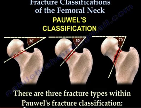 Femoral neck fracture classification — OrthopaedicPrinciples.com