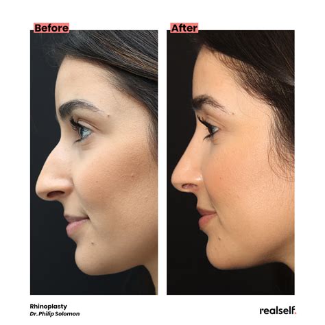 nose job recovery stages - Olympia Correa