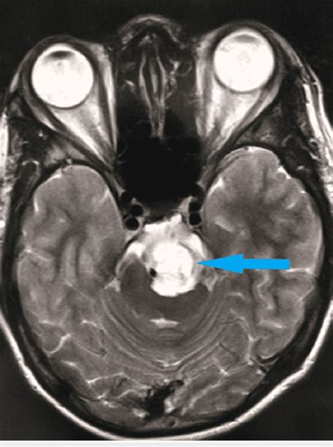 T2 axial MRI scan of the brain shows a hyperintense lesion in the... | Download Scientific Diagram