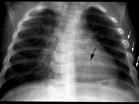 Bruised Rib - Symptoms, Treatment, Signs, Causes, X-ray Diagnosis