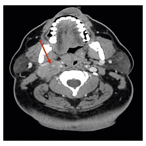 CT scan of the neck and soft tissue showing and infiltrative mass on ...