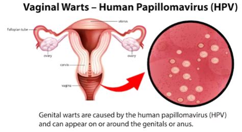 Vaginal Wart