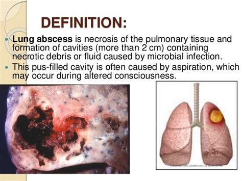 Common suppurative diseases of lung- Bronchiectasis...!