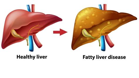 Steatotic liver disease: Symptoms, risk factors and prevention of non-alcoholic fatty liver ...