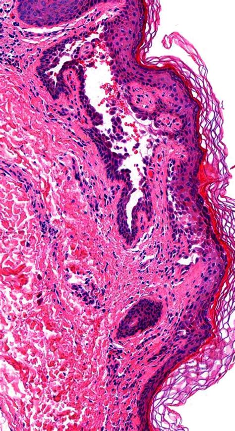 Pathology of Hailey-Hailey Disease | Histology slides, Pathology, Save