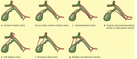 Laparoscopic Cholecystectomy Anatomy