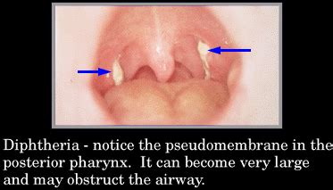 Diphtheria