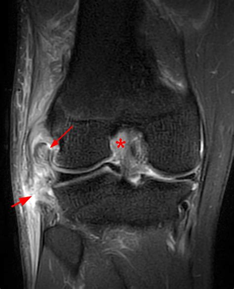 Pathology of the Popliteus Tendon | Radsource