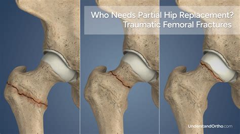 Partial Hip Replacement – UnderstandOrtho™