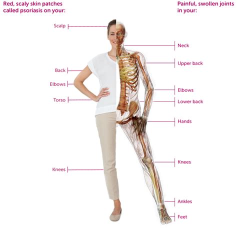 Psoriatic Arthritis Signs & Symptoms | HUMIRA® (adalimumab)