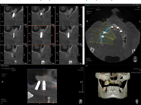 Figure 4 from Maxillary Sinus Osteoma as a Support for Dental Implant Associated to Sinus ...