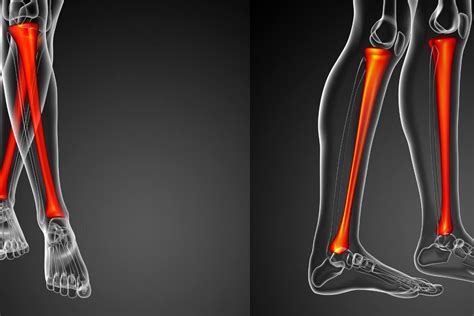 Limb Lengthening | Soraca Medical