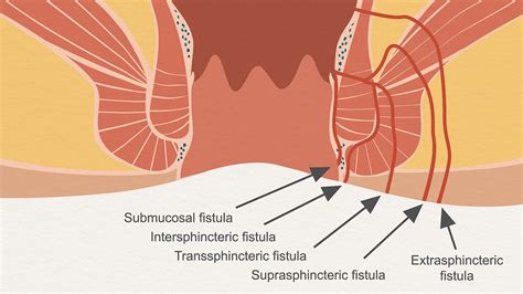 Proctology Laser for Fistula