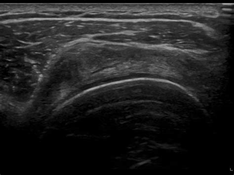 Supraspinatus full thickness tear | Ultrasound Cases