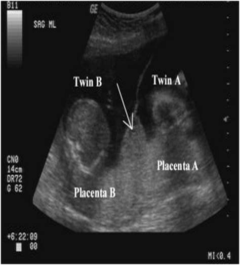 Twin Pregnancy – Risk Stratification : Need of the hour ! – Apollo ...