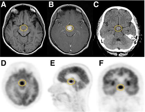 Hypothalamus Mri Axial