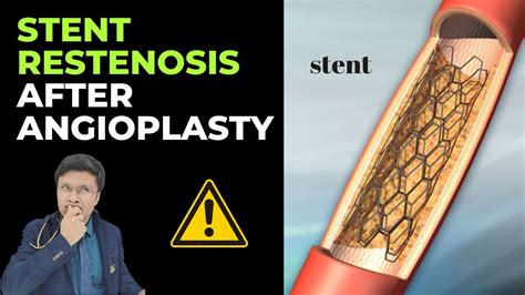 Unveiling the Risk Factors for In-Stent Restenosis after Angioplasty! 🚩 (Must-Watch)" - YouTube