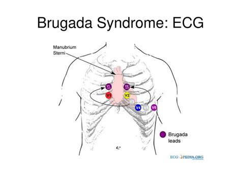 PPT - Brugada’s Syndrome and Sudden Cardiac Death PowerPoint Presentation - ID:764012