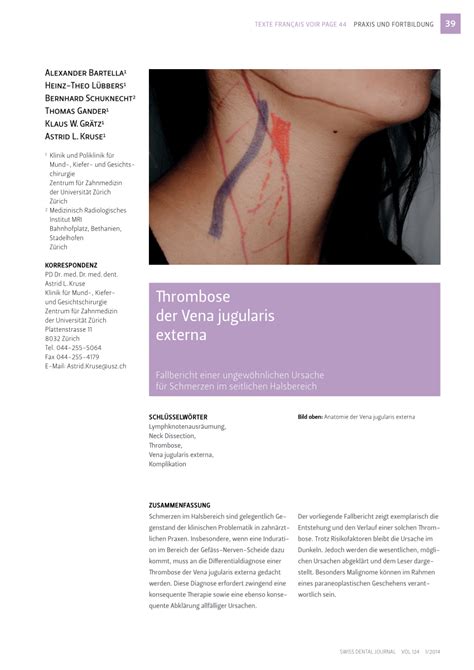 (PDF) Thrombosis of the external jugular vein. Case report of a rare ...