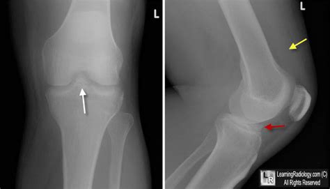 Intercondylar Eminence