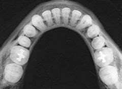 Dental radiography or dental X-ray