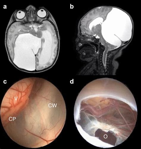 a Brain MRI. An axial T2-weighted image shows a large choroidal fissure... | Download Scientific ...