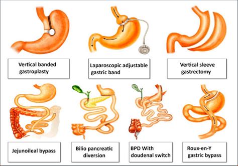 Weight Loss Management With Bariatric Surgery - India Laparoscopy Surgery Site Blog