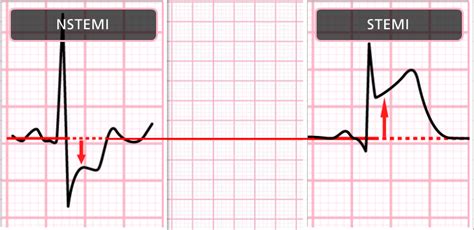 CVT Mohd Farid: ECG & Echocardiography Case Study Chronic Myocardial Infarction-Credit Cardio ...