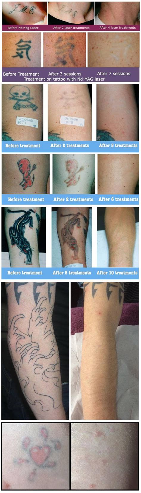 Laser tattoo removal treatment in Worcestershire - Outline Clinic Droitwich