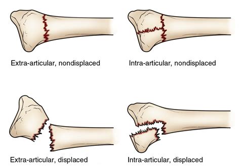 Wrist Fractures – Surgically Dr. George Morrison