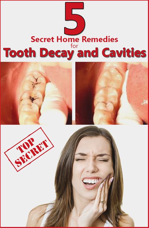 5 Secret Home Remedies for Tooth Decay and Cavities | Natural Tooth ...