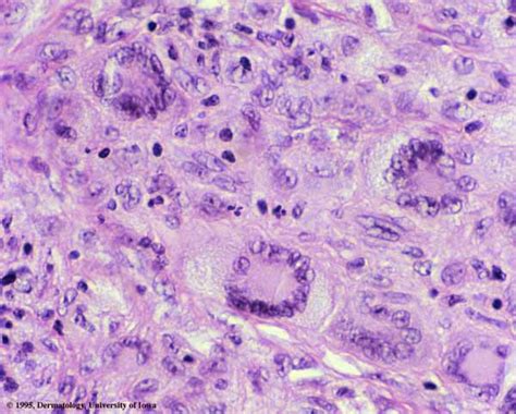 xanthogranuloma skin histology